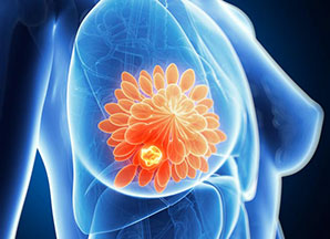 Detailed genetic picture of breast cancer revealed