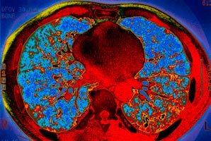 High-tech imaging could stop TB spread