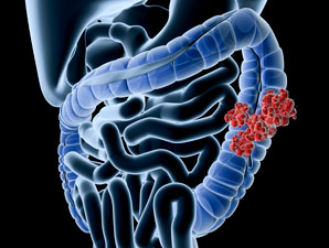 Why cancer stem cells are so hard to beat