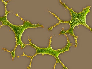 Enzyme action behind drug-resistant breast cancer