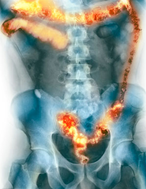 Bowel disease drug shows unexpected mechanism