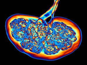 Drugs reverse kidney condition in mice
