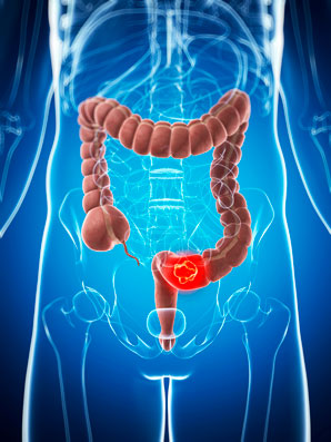 How mutations join forces to drive colorectal cancer progression