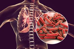 A prognostic indicator for tuberculosis