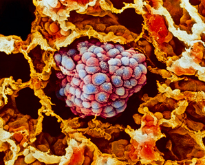 A metabolic gene variant promotes tumour growth