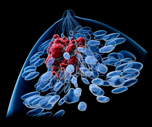 Resident immune cells underpin body’s response to breast cancer
