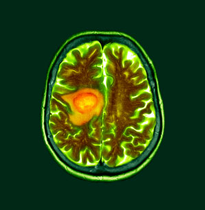 The source of a brain tumour’s aggressiveness found