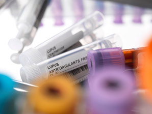 A new therapeutic lead for lupus