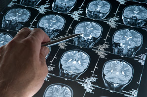 Drug repurposed to alleviate epileptic seizures