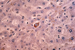 A new target for breast cancer stem-like cells