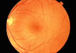 Eye disease inherited in novel way