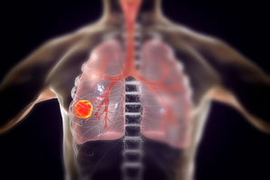 Early genomic changes can spur cancer decades later