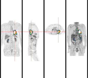 A novel peptide drug for cancer diagnosis and treatment