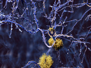 Link between hyperactive brain cells and Alzheimer’s disease uncovered