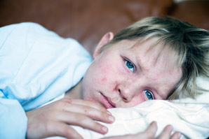 Measles wipes out immune memory