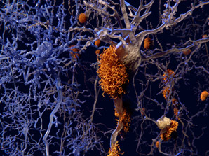 Experimental Alzheimer’s treatment keeps it simple