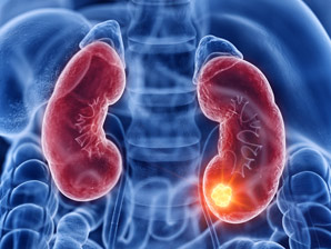 A precision medicine boost for kidney cancer