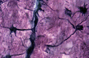 Astrocytes can make Alzheimer’s worse