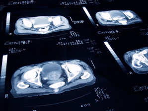 Fat attack on prostate cancer