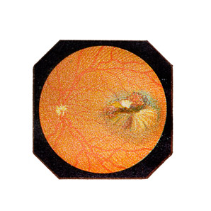 A complex cause of heritable blindness