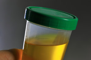 A simple urine biomarker assay