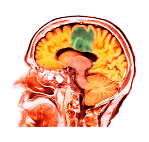 White blood cells that fight against brain tumours